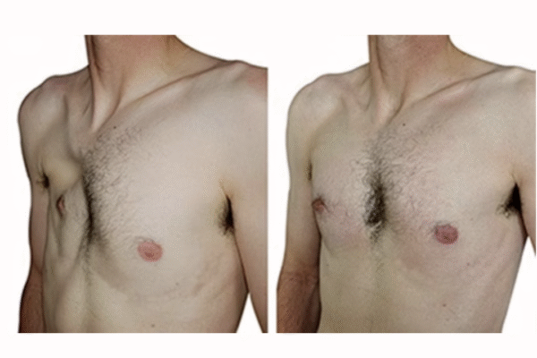 Patient with Poland's Syndrome and after treatment