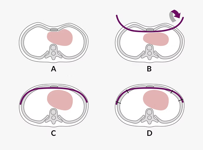 Schematic drawing of the Wung procedure